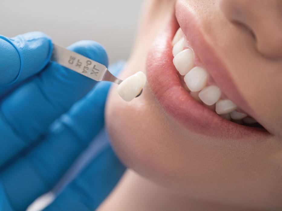 dentist holding up a tooth swatch | Teeth Whitening in Wausau WI